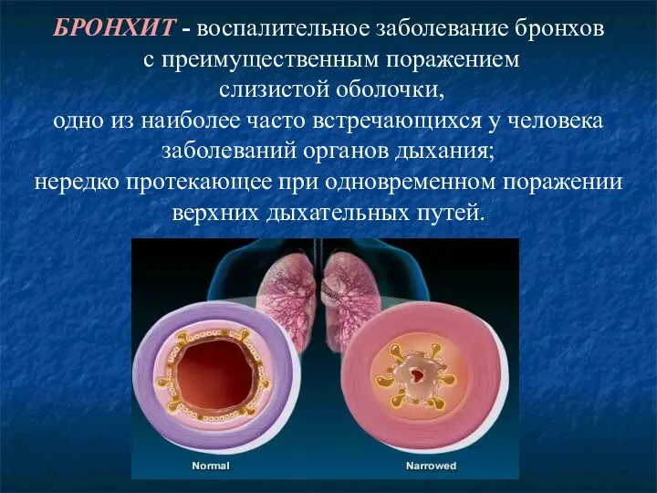 БРОНХИТ - воспалительное заболевание бронхов с преимущественным поражением слизистой оболочки, одно из