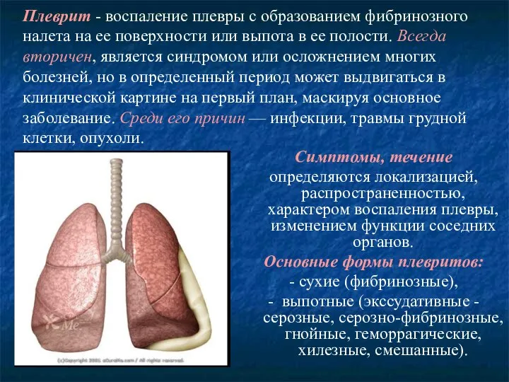 Плеврит - воспаление плевры с образованием фибринозного налета на ее поверхности или