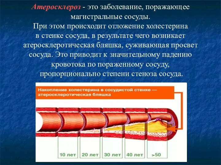 Атеросклероз - это заболевание, поражающее магистральные сосуды. При этом происходит отложение холестерина