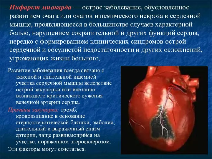 Инфаркт миокарда — острое заболевание, обусловленное развитием очага или очагов ишемического некроза