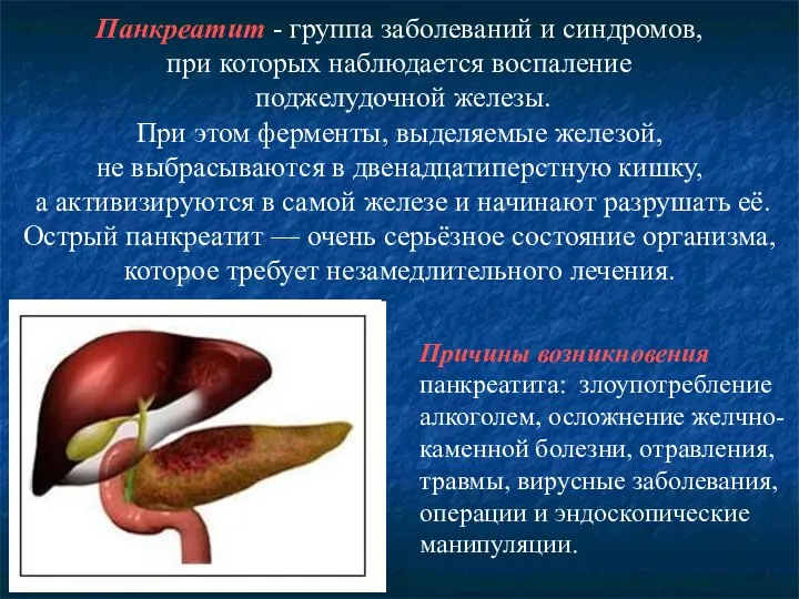 Панкреатит - группа заболеваний и синдромов, при которых наблюдается воспаление поджелудочной железы.