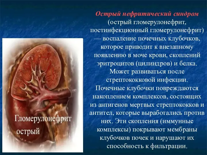 Острый нефритический синдром (острый гломерулонефрит, постинфекционный гломерулонефрит) — воспаление почечных клубочков, которое