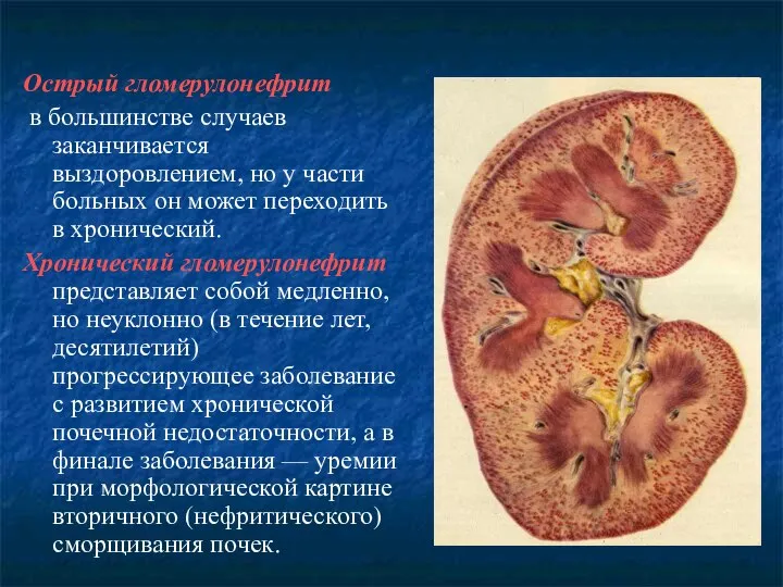 Острый гломерулонефрит в большинстве случаев заканчивается выздоровлением, но у части больных он