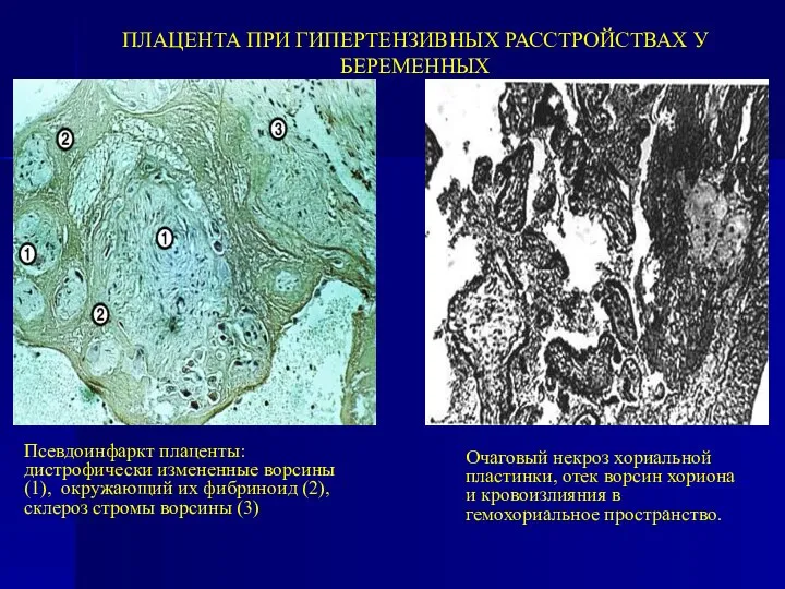 ПЛАЦЕНТА ПРИ ГИПЕРТЕНЗИВНЫХ РАССТРОЙСТВАХ У БЕРЕМЕННЫХ Псевдоинфаркт плаценты: дистрофически измененные ворсины (1),