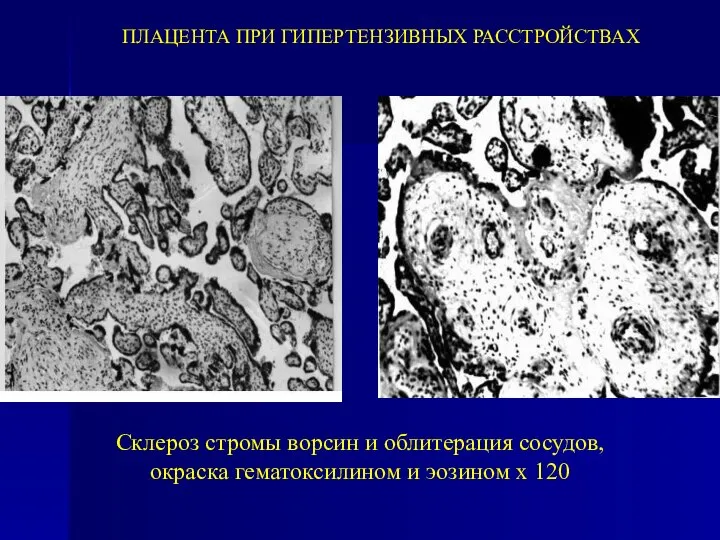 ПЛАЦЕНТА ПРИ ГИПЕРТЕНЗИВНЫХ РАССТРОЙСТВАХ Склероз стромы ворсин и облитерация сосудов, окраска гематоксилином и эозином х 120