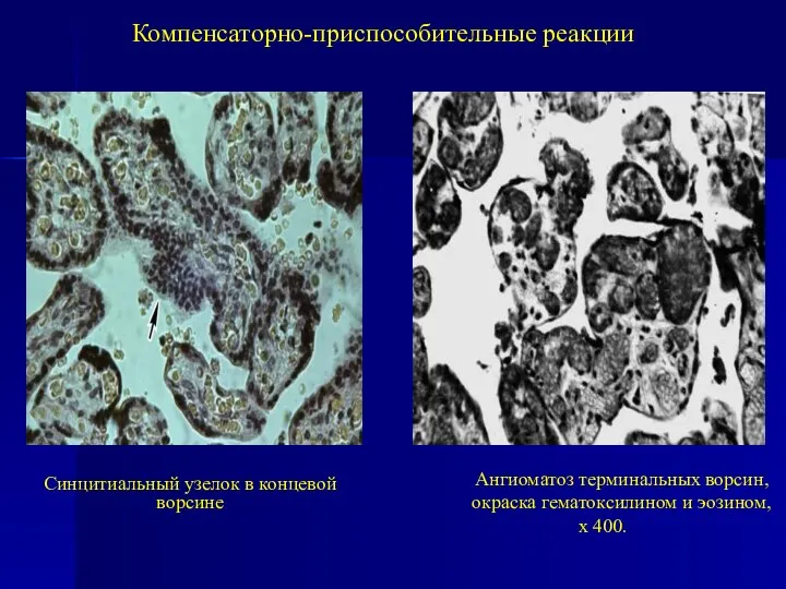 Компенсаторно-приспособительные реакции Синцитиальный узелок в концевой ворсине Ангиоматоз терминальных ворсин, окраска гематоксилином и эозином, х 400.