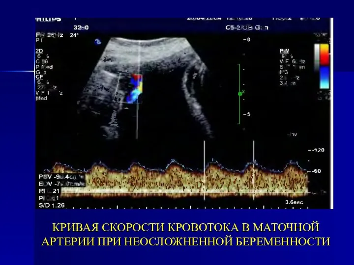 КРИВАЯ СКОРОСТИ КРОВОТОКА В МАТОЧНОЙ АРТЕРИИ ПРИ НЕОСЛОЖНЕННОЙ БЕРЕМЕННОСТИ