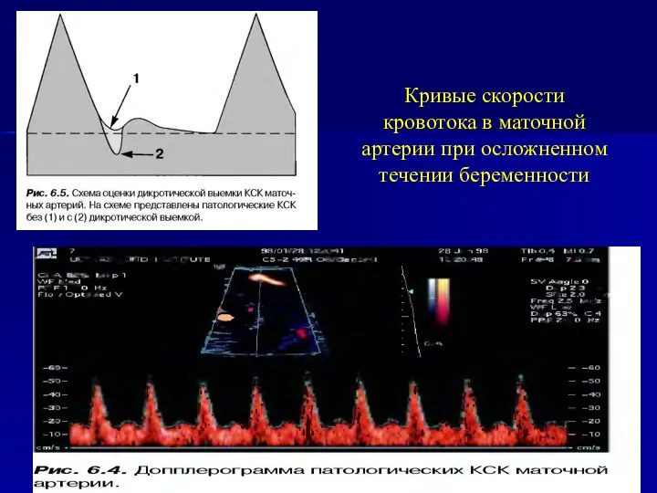 Кривые скорости кровотока в маточной артерии при осложненном течении беременности