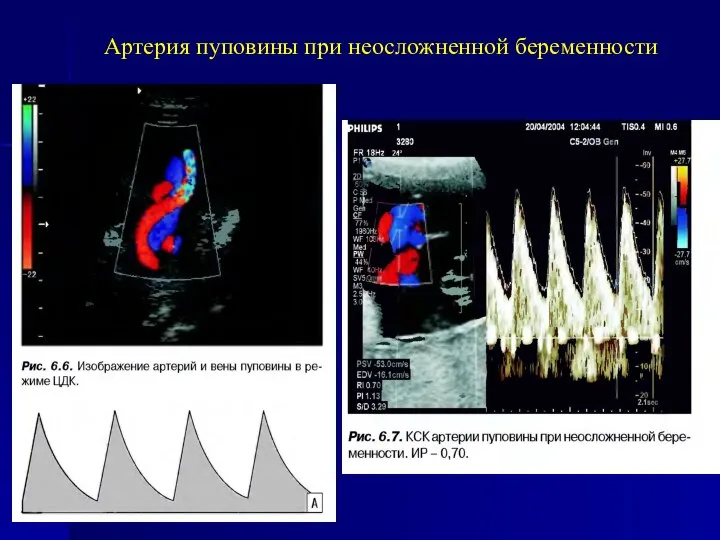 Артерия пуповины при неосложненной беременности