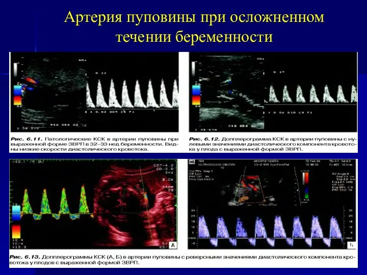 Артерия пуповины при осложненном течении беременности
