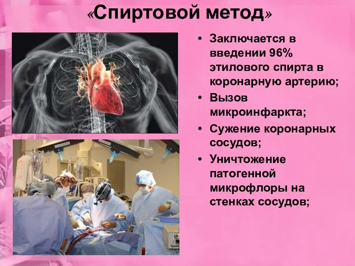 «Спиртовой метод» Заключается в введении 96% этилового спирта в коронарную артерию; Вызов