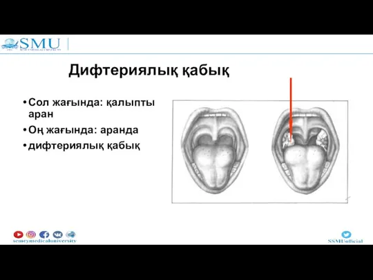 Дифтериялық қабық Сол жағында: қалыпты аран Оң жағында: аранда дифтериялық қабық