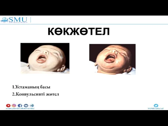 1.Ұстаманың басы 2.Конвульсивті жөтел КӨКЖӨТЕЛ