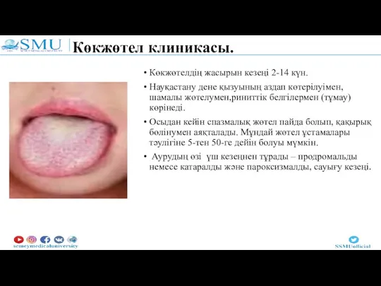 Көкжөтел клиникасы. Көкжөтелдің жасырын кезеңі 2-14 күн. Науқастану дене қызуының аздап көтерілуімен,