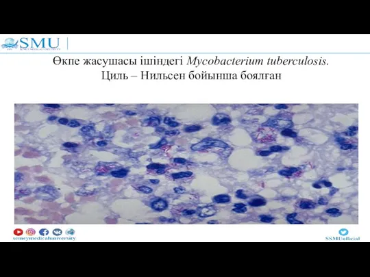 Өкпе жасушасы ішіндегі Mycobacterium tuberculosis. Циль – Нильсен бойынша боялған