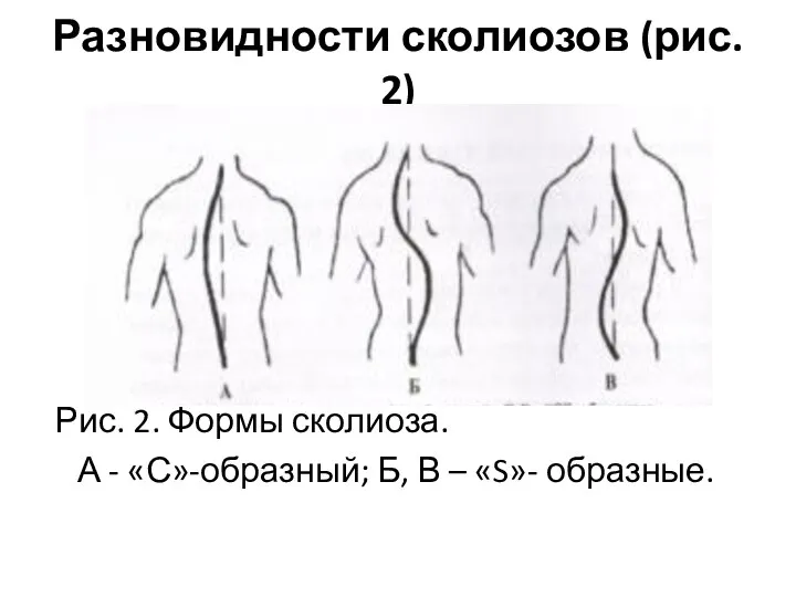 Разновидности сколиозов (рис. 2) Рис. 2. Формы сколиоза. А - «С»-образный; Б, В – «S»- образные.