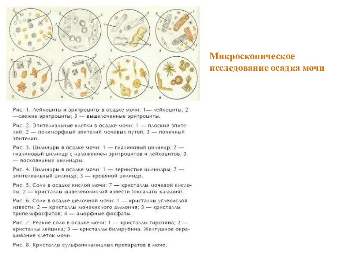 Микроскопическое исследование осадка мочи