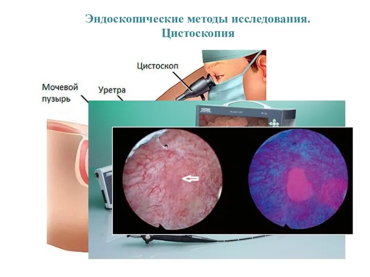 Эндоскопические методы исследования. Цистоскопия