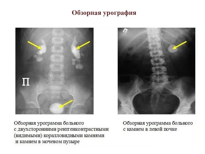 Обзорная урография