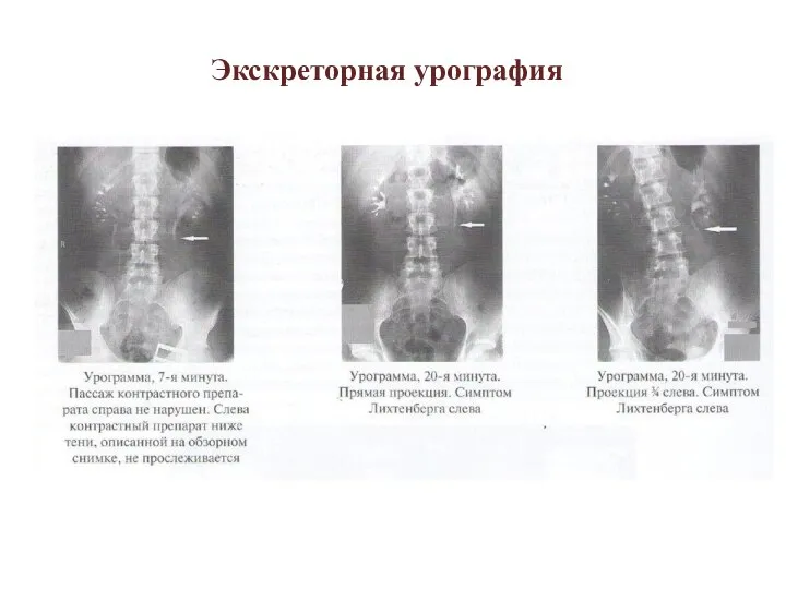 Экскреторная урография