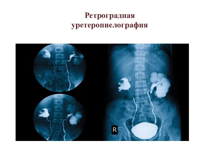 Ретроградная уретеропиелография