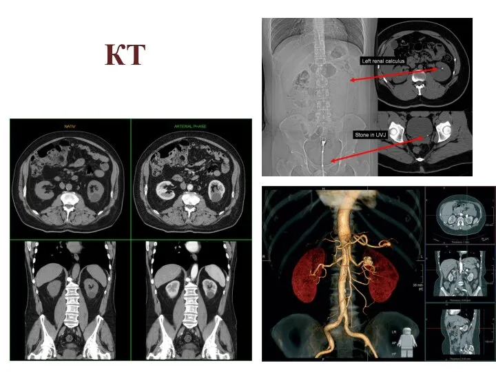КТ