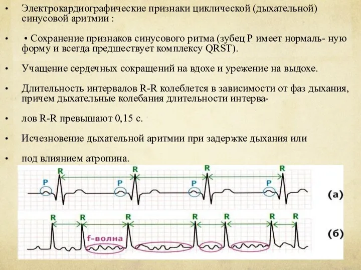 Электрокардиографические признаки циклической (дыхательной) синусовой аритмии : • Сохранение признаков синусового ритма