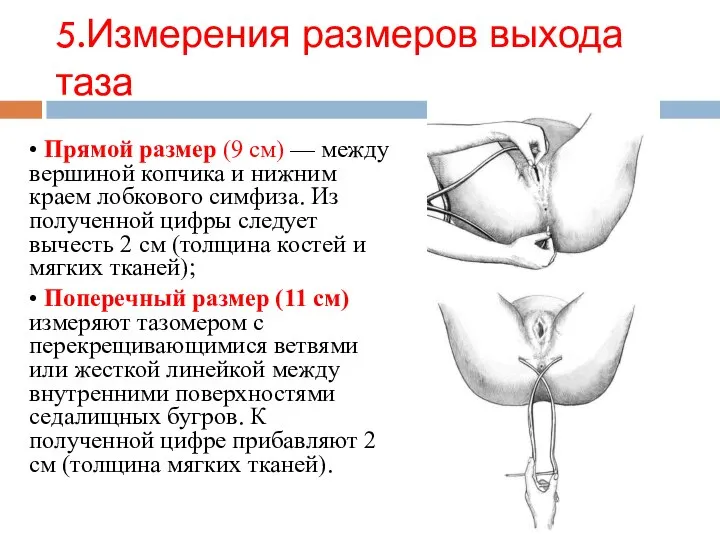 5.Измерения размеров выхода таза • Прямой размер (9 см) — между вершиной