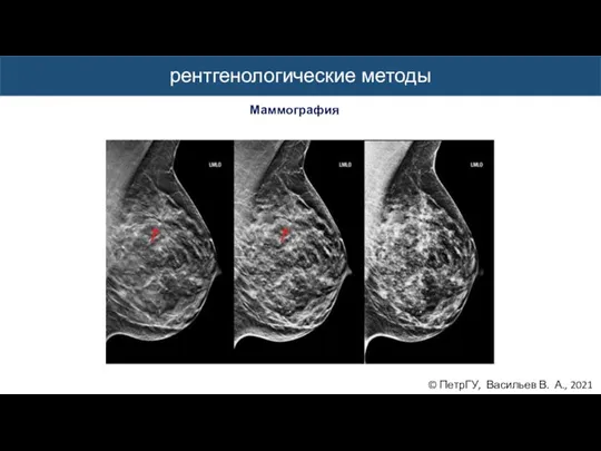 © ПетрГУ, Васильев В. А., 2021 рентгенологические методы Маммография