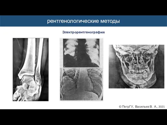 © ПетрГУ, Васильев В. А., 2021 рентгенологические методы Электрорентгенография