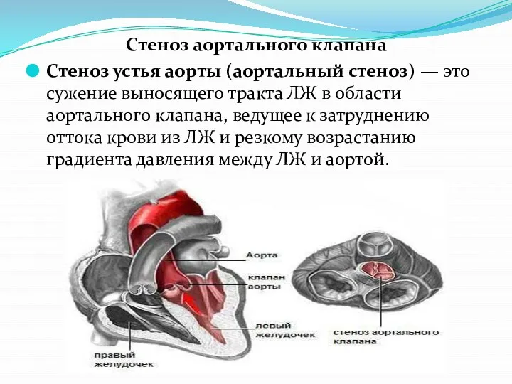 Стеноз аортального клапана Стеноз устья аорты (аортальный стеноз) — это сужение выносящего