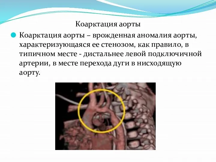 Коарктация аорты Коарктация аорты – врожденная аномалия аорты, характеризующаяся ее стенозом, как