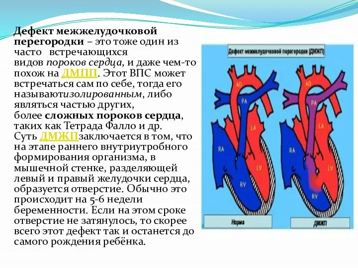 Дефект межжелудочковой перегородки – это тоже один из часто встречающихся видов пороков