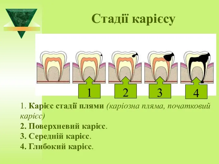 Стадії карієсу 1. Карієс стадії плями (каріозна пляма, початковий карієс) 2. Поверхневий