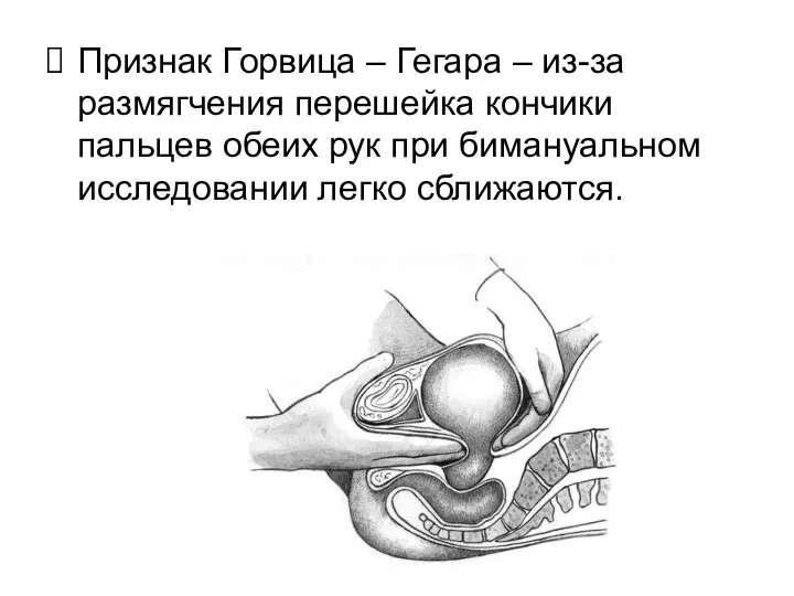 Признак Горвица – Гегара – из-за размягчения перешейка кончики пальцев обеих рук