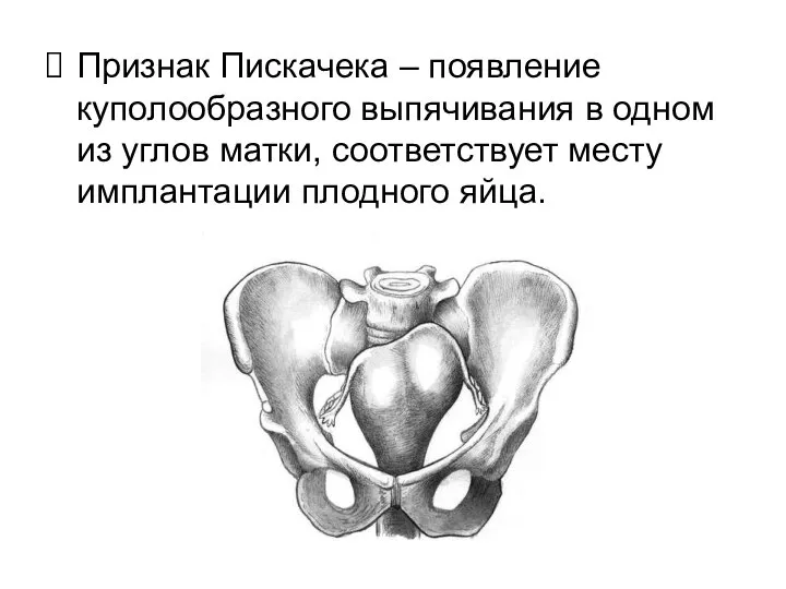 Признак Пискачека – появление куполообразного выпячивания в одном из углов матки, соответствует месту имплантации плодного яйца.