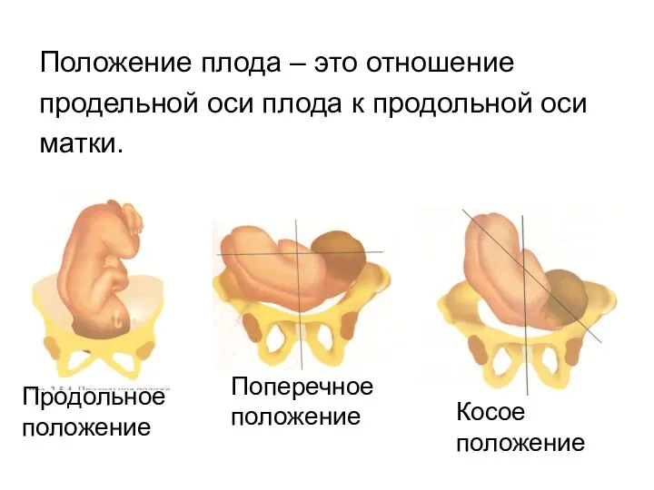 Положение плода – это отношение продельной оси плода к продольной оси матки.