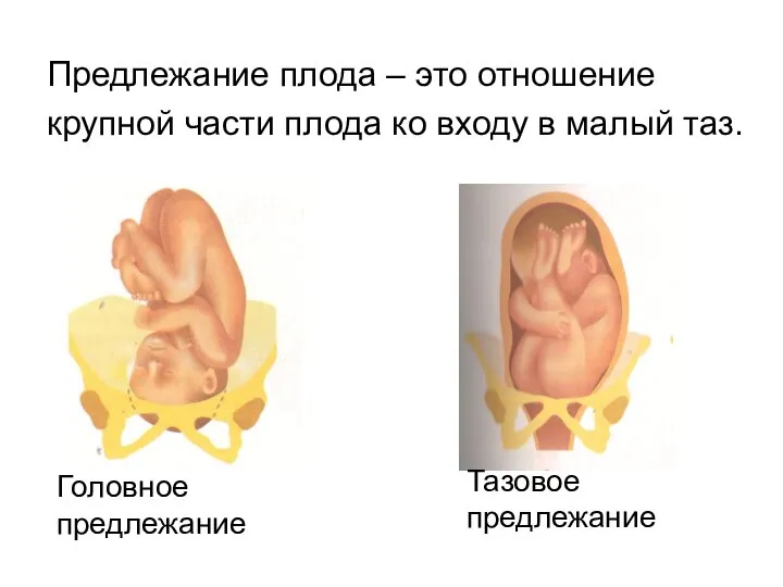 Предлежание плода – это отношение крупной части плода ко входу в малый