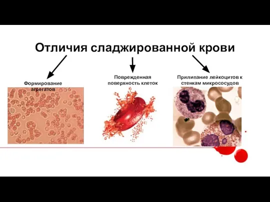 Отличия сладжированной крови Формирование агрегатов Поврежденная поверхность клеток Прилипание лейкоцитов к стенкам микрососудов