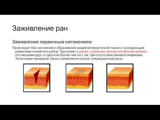 Заживление ран Заживление первичным натяжением Происходит без нагноения и образования видимой межуточной