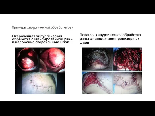 Примеры хирургической обработки ран Отсроченная хирургическая обработка скальпированной раны и наложение отсроченных