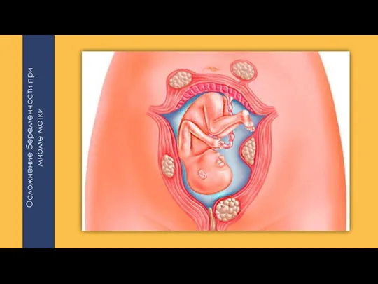 Осложнение беременности при миоме матки