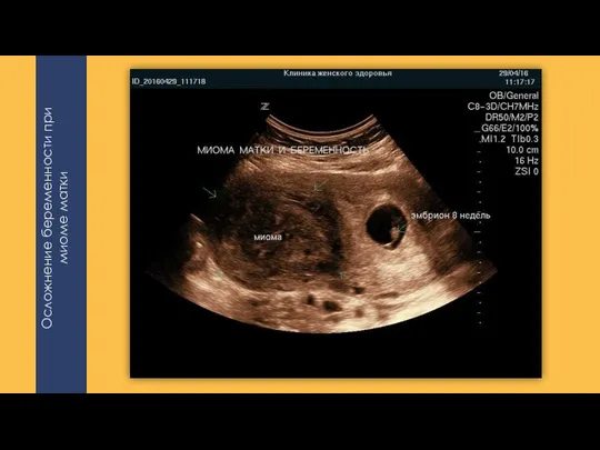 Осложнение беременности при миоме матки
