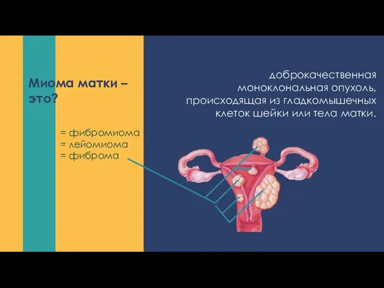 доброкачественная моноклональная опухоль, происходящая из гладкомышечных клеток шейки или тела матки. Миома