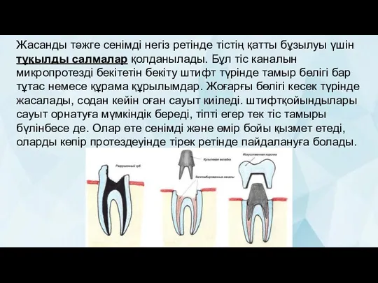 Жасанды тәжге сенімді негіз ретінде тістің қатты бұзылуы үшін тұқылды салмалар қолданылады.