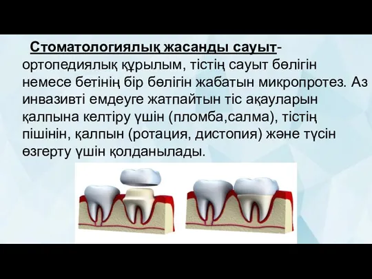 Стоматологиялық жасанды сауыт-ортопедиялық құрылым, тістің сауыт бөлігін немесе бетінің бір бөлігін жабатын