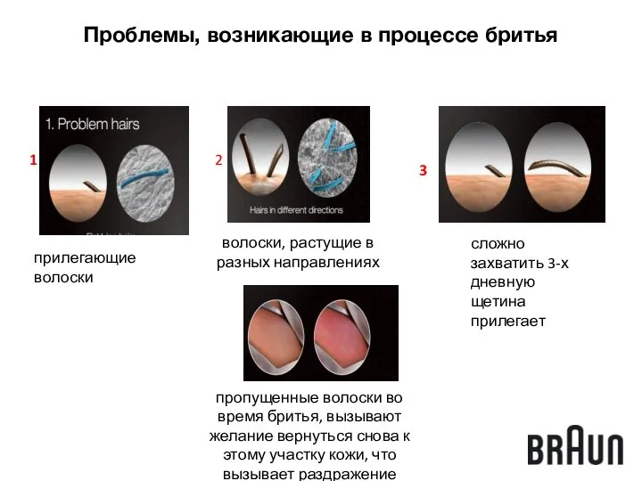 Проблемы, возникающие в процессе бритья прилегающие волоски волоски, растущие в разных направлениях