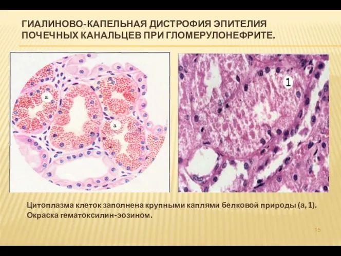 ГИАЛИНОВО-КАПЕЛЬНАЯ ДИСТРОФИЯ ЭПИТЕЛИЯ ПОЧЕЧНЫХ КАНАЛЬЦЕВ ПРИ ГЛОМЕРУЛОНЕФРИТЕ. Цитоплазма клеток заполнена крупными каплями