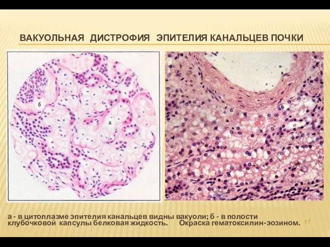 ВАКУОЛЬНАЯ ДИСТРОФИЯ ЭПИТЕЛИЯ КАНАЛЬЦЕВ ПОЧКИ а - в цитоплазме эпителия канальцев видны