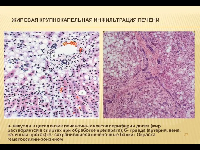 ЖИРОВАЯ КРУПНОКАПЕЛЬНАЯ ИНФИЛЬТРАЦИЯ ПЕЧЕНИ а- вакуоли в цитоплазме печеночных клеток периферии долек